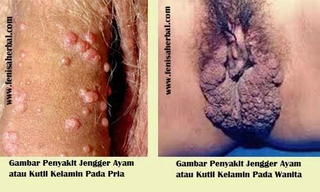 Illustration for article titled Kumpulan Obat Kutil Di Apotik